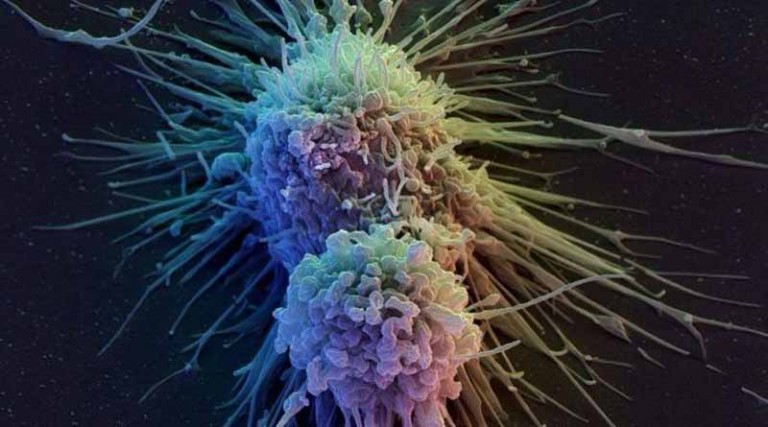 Καρκίνος: Πρωτοποριακή θεραπεία εξαφάνισε όγκο!