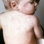 «Χτυπούν» καμπανάκι για την ιλαρά και οι επισκέπτες υγείας – Ζητούν τον εμβολιασμό παιδιών και ενηλίκων