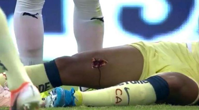 Ανατριχιαστικός τραυματισμός! Του άνοιξε τρύπα στο πόδι! (video)