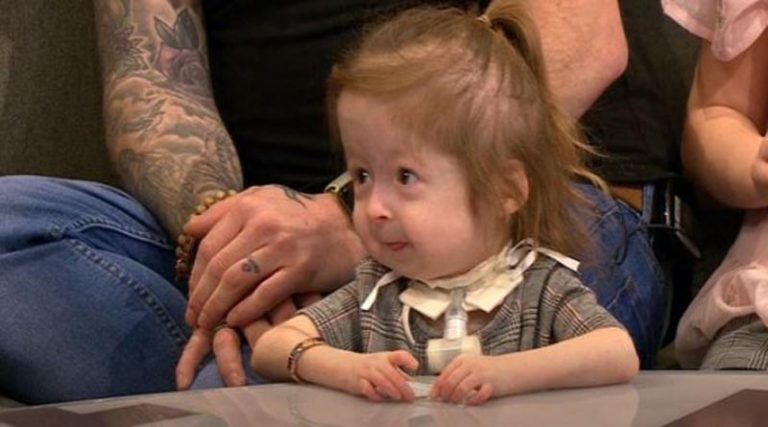 Το κορίτσι «Μπέντζαμιν Μπάτον»: Είναι μόλις 2 ετών και γερνάει πρόωρα! (video)