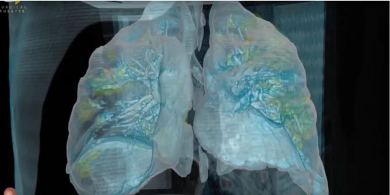 Κορονοϊός: Πώς «χτυπά» τους πνεύμονες των ασθενών, ποιοι και γιατί κινδυνεύουν περισσότερο