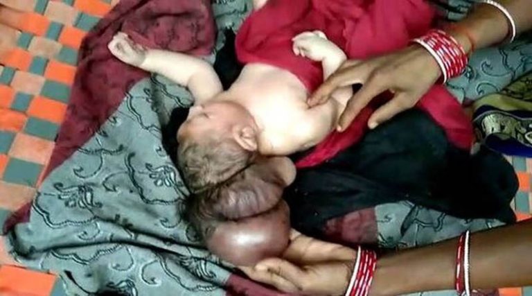 Απίστευτο ιατρικό περιστατικό: Γεννήθηκε μωρό με τρία κεφάλια! (φωτό)