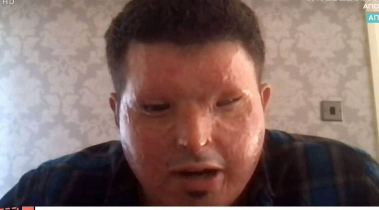 Ανδρέας Χριστοφέρος: Συγκλονίζει μιλώντας για την επίθεση με οξύ που έχει δεχτεί – Το μήνυμά στην Ιωάννα Παλιοσπύρου (βίντεο)