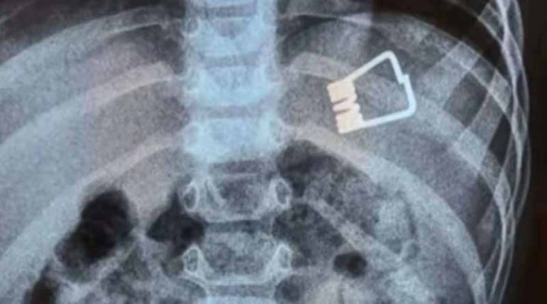 Αγοράκι δυο ετών κατάπιε μανταλάκι – Πώς το έσωσαν γιατροί χωρίς χειρουργείο