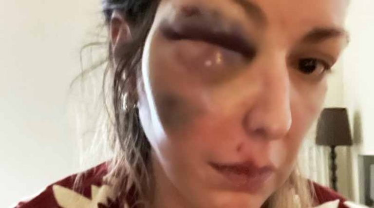 Παραμορφωμένη γνωστή Ελληνίδα δημοσιογράφος – Την χτύπησε ο σύντροφός της – Δημοσίευσε εικόνες