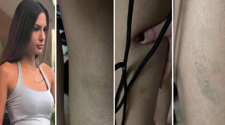 Ανατριχίλα προκαλούν οι μώλωπες στο σώμα της Γεωργίας μετά τον βιασμό