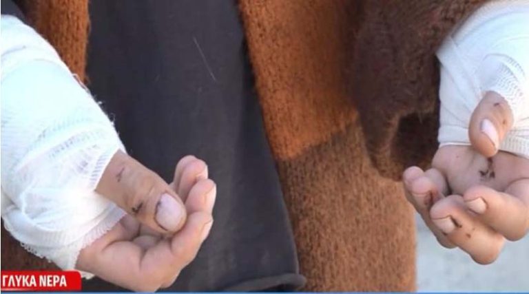 Γλυκά Νερά: Σοκάρει η γυναίκα που δέχθηκε άγρια επίθεση από πίτμπουλ –  «Τα χέρια μου αχρηστεύτηκαν» (βίντεο)