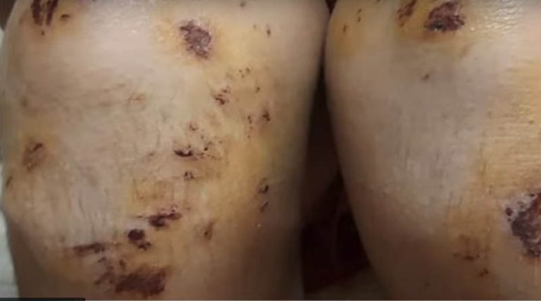 Σοκ από τη νέα οπαδική επίθεση σε 14χρονο – Υπέστη αιμάτωμα στο συκώτι από τον ξυλοδαρμό! (βίντεο)