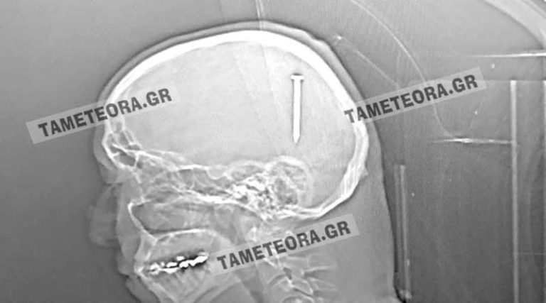 Καρφί 5 εκατοστών σφηνώθηκε στο κεφάλι άνδρα στην Καλαμπάκα! (φωτό)