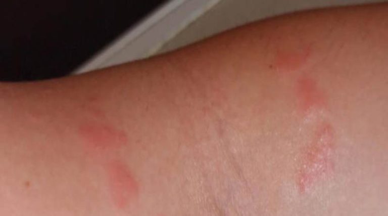 Μωβ μέδουσες: Διπλή επίθεση σε γυναίκα – Δείτε τα σημάδια στα χέρια της! (φωτό)