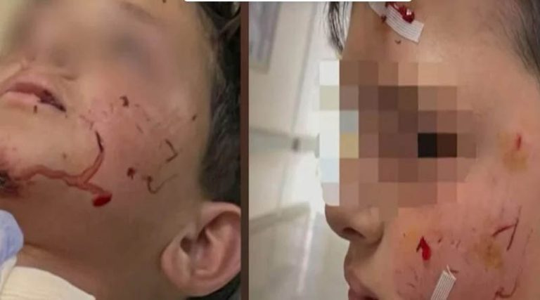 Συγκλονίζει η μητέρα του 14χρονου που δέχθηκε επίθεση σκύλου στο Λαγονήσι: Αν δεν ήταν ένας μπαμπάς κοντά, θα τον είχε σκοτώσει
