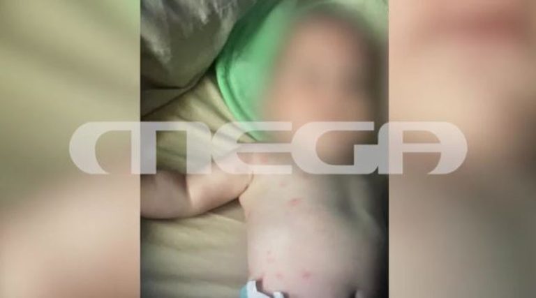 Γεμάτο με τσιμπήματα από ψύλλους το μωρό που δολοφονήθηκε από τον πατέρα του (φωτό & βίντεο)