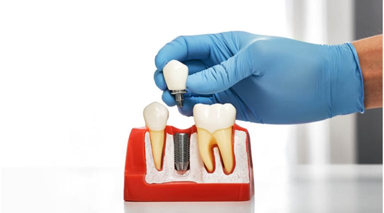 Αναγέννηση οστού για οδοντικά εμφυτεύματα