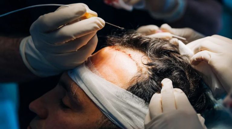 Πολυιατρείο στην Αττική έκανε εμφυτεύσεις μαλλιών χωρίς την παρουσία εξειδικευμένου προσωπικού